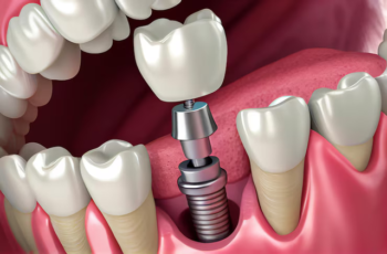 implants dentaires Hongrie